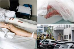 Sári Morg Gergö is still in the hospital recovering from the burn.