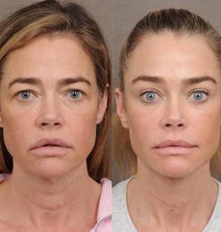 Ótrúleg breyting fyrir og eftir fegrunaraðgerð