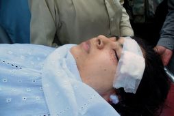 Malala Yousafzai eftir árásina í október árið 2012.