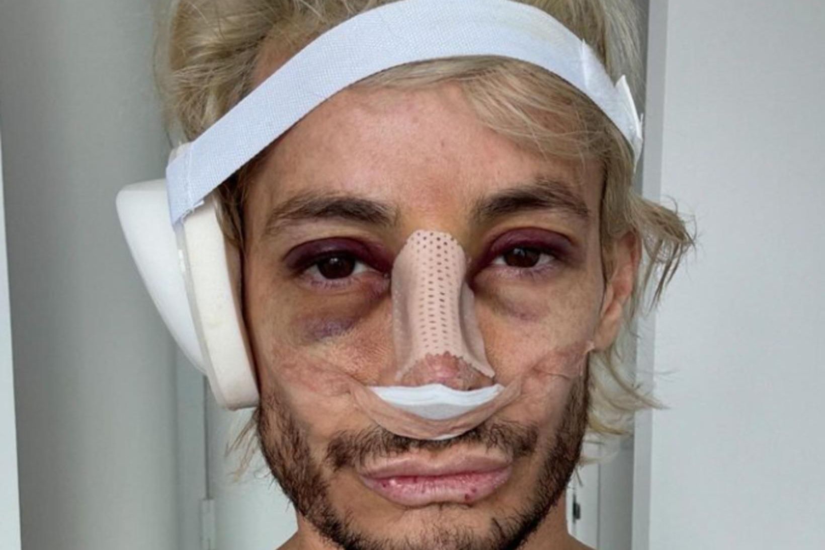 YouTube-stjarnan Frankie Grande, bróðir Ariana Grande, vonast eftir að nefaðgerðin …
