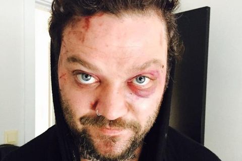 The photograph published by Bam Margera of his battered face.