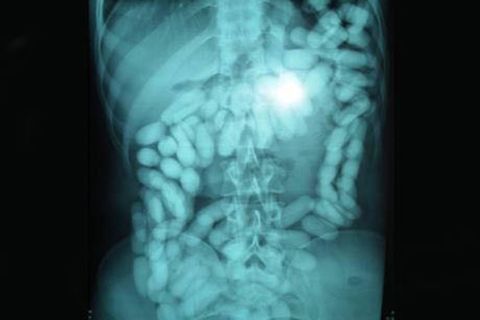 An X-ray showing the man's intentestines and stomach carrying a kilo of cocaine.
