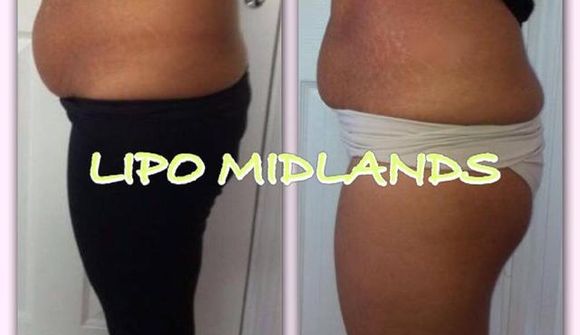 Lýtalæknir mælir ekki með  „Lipoglaze“aðferðinni