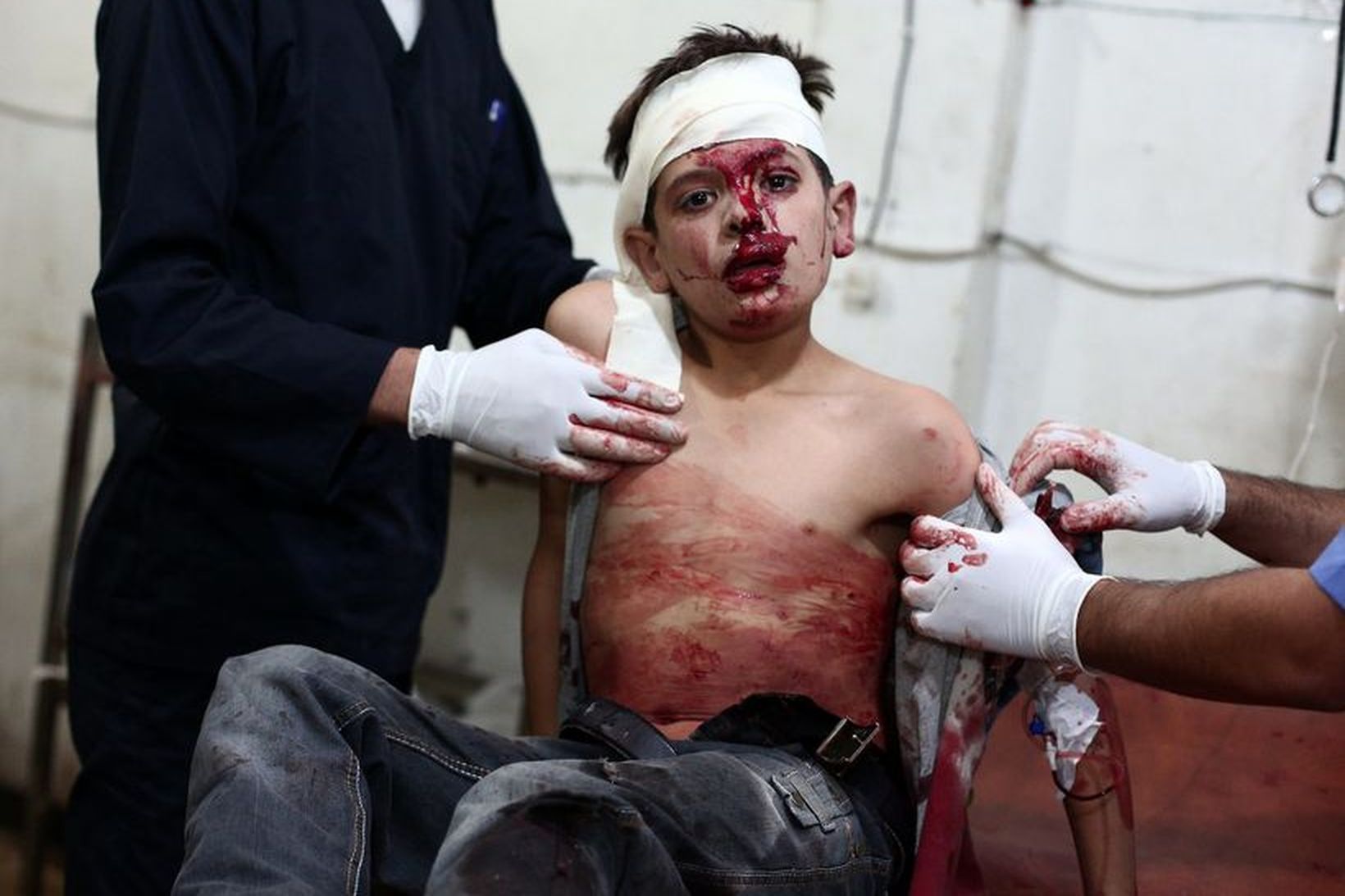 Sýrlenskur drengur sem særðist í árás í borginni Douma í …