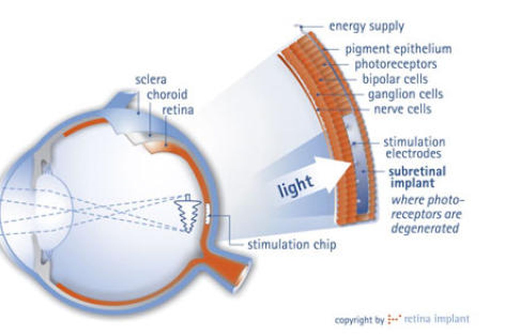 Af heimasíðu Retina Implant - framleiðanda örflögunnar