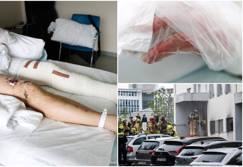 Sári Morg Gergö is still in the hospital recovering from the burn.